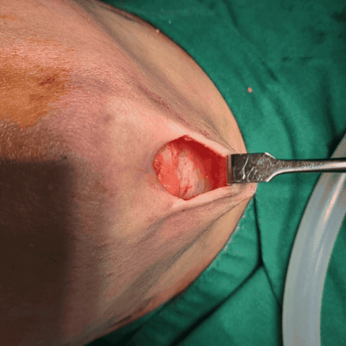 01 이중턱 지방흡입 후 빈 지방층_500.gif