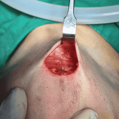 04 이중턱 근육묶기 후_500.gif