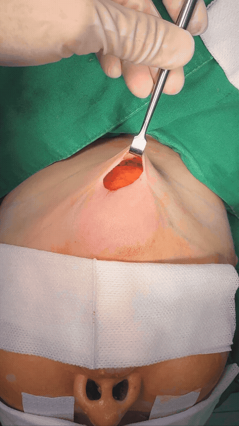 지방흡입 후에도 남아있는 피하지방.gif