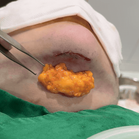 근육묶기 시 제거한 속지방.gif