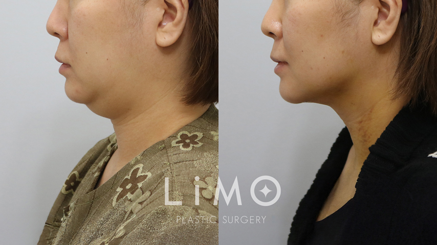 이중턱 근육묶기 1주