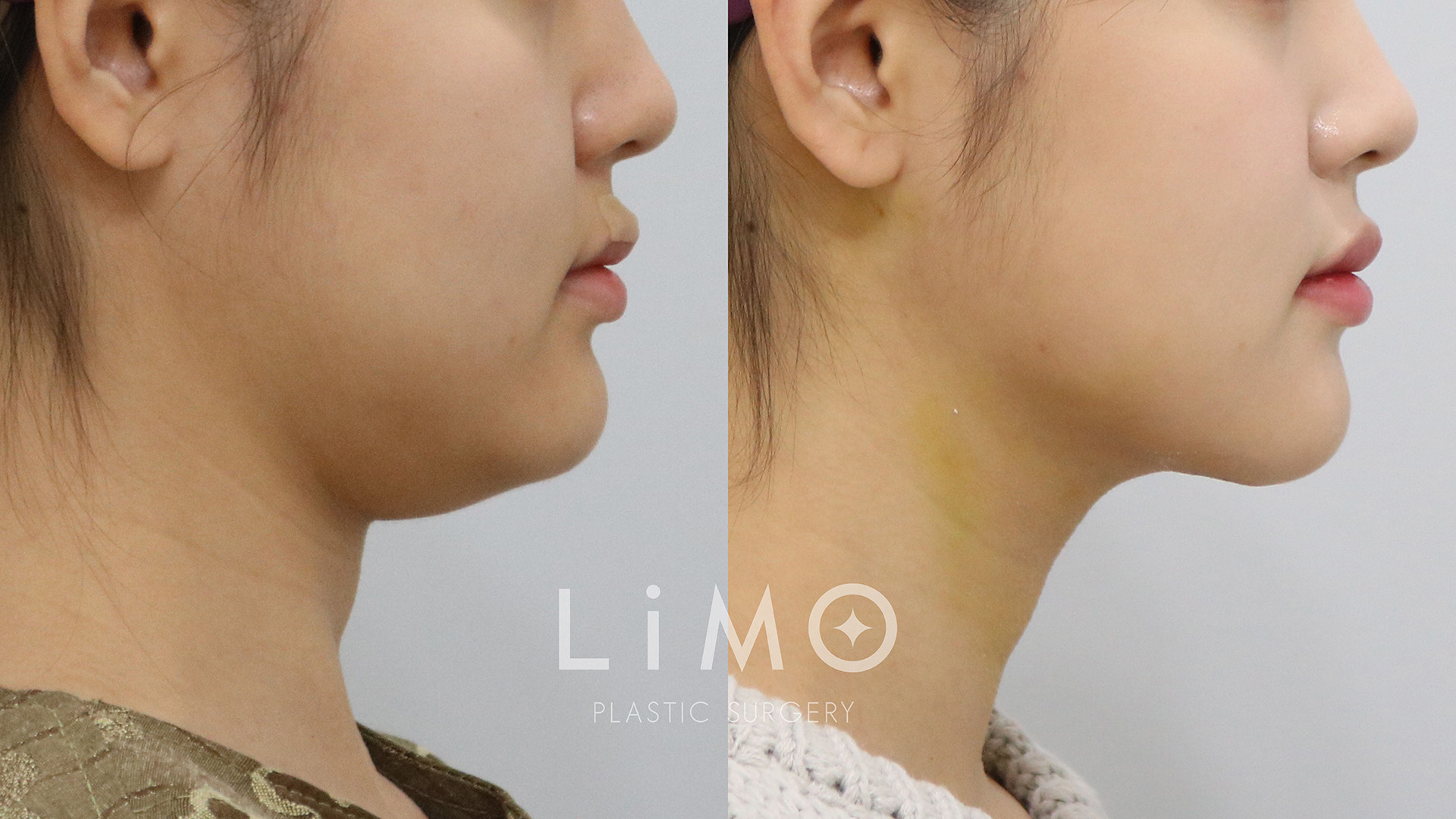 이중턱 근육묶기 1주