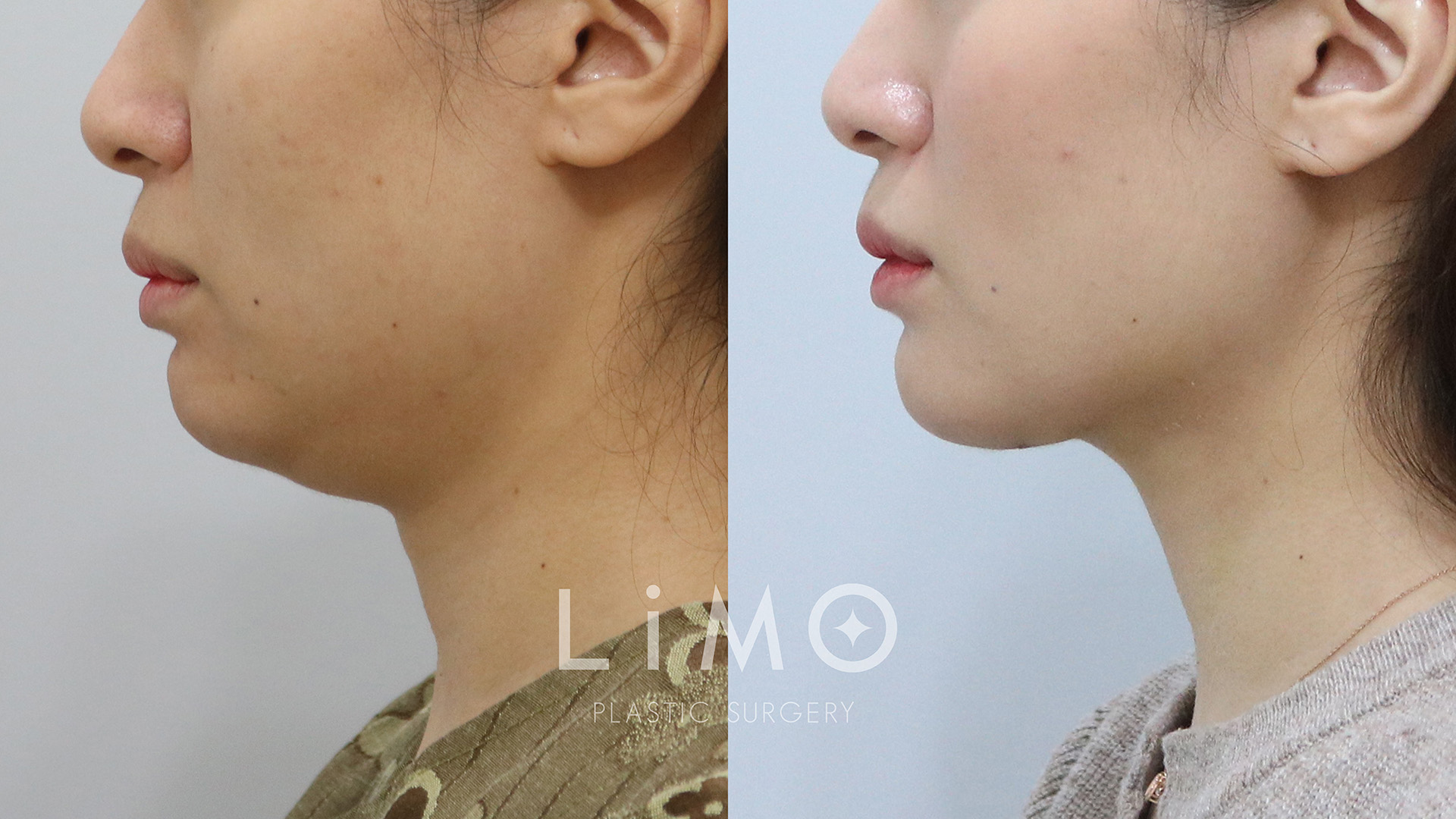 이중턱 근육묶기 11일