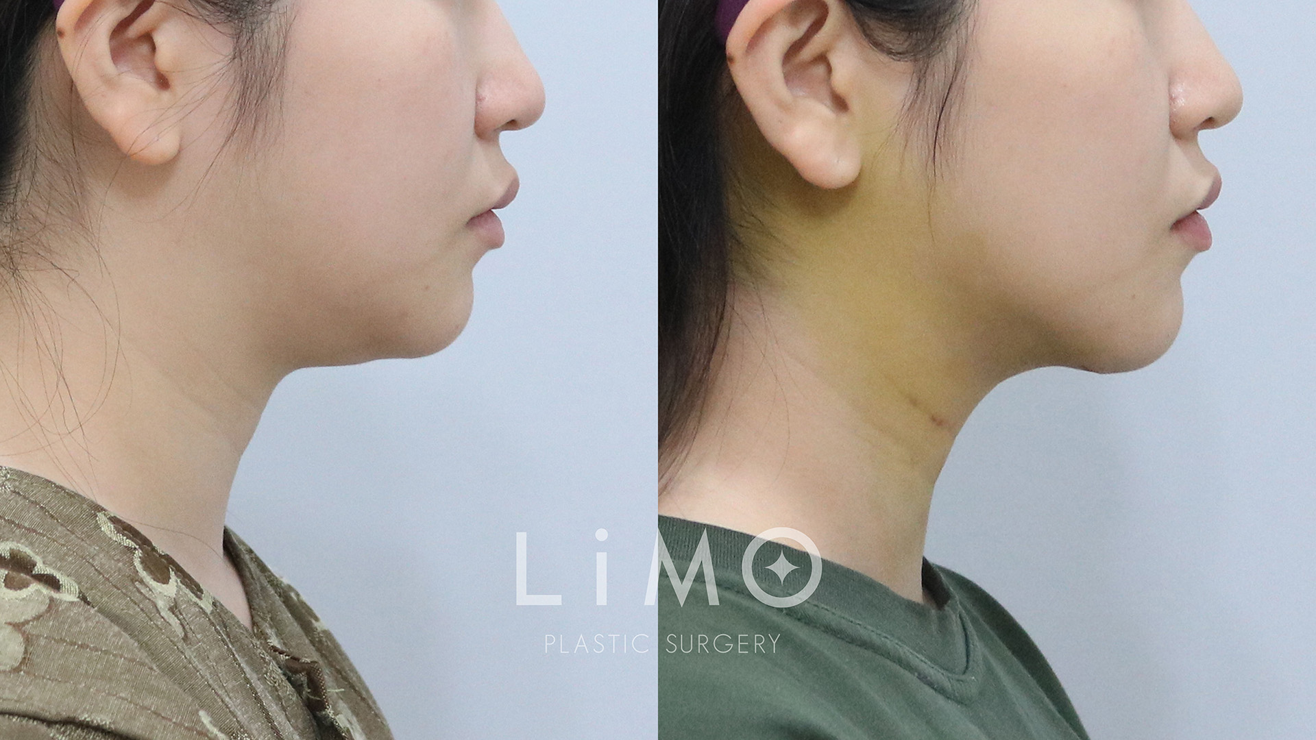 이중턱 근육묶기 1주